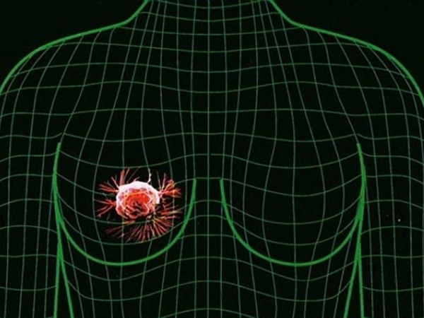 Que la fibroadenomatosis es peligrosa