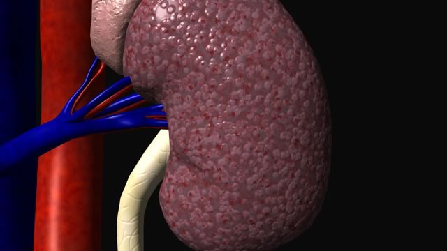 Infarto de riñón: causas, síntomas, tratamiento