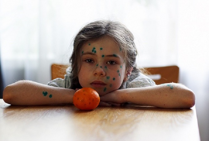 ¿Cuántos días están enfermos los niños con varicela